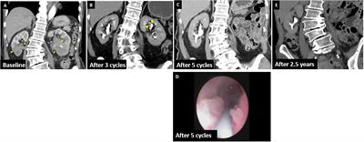 Case Report: Neoadjuvant immunotherapy with pembrolizumab alone for bilateral upper tract urothelial carcinoma is a feasible strategy for kidney sparing and avoidance of hemodialysis